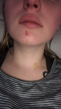 Advocate Tara O'Connor showing bruises and scrapes on her chin and neck 5 days after a fall